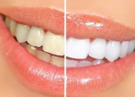 سفید کردن دندان (bleaching) چیست؟ مزایا و معایب سفید کردن دندان چیست؟