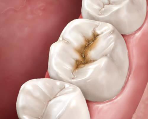 نتایج یک تحقیق درباره رابطه پوسیدگی دندان با سرطان روده وخیم
