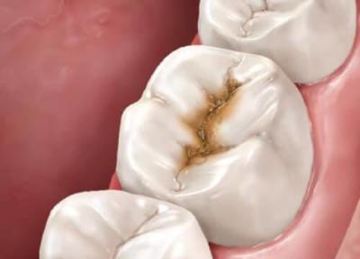 نتایج یک تحقیق درباره رابطه پوسیدگی دندان با سرطان روده وخیم