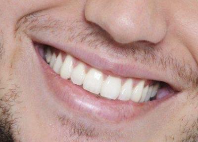 سفیدکننده های دندان چه آسیبی به دندان ها می زنند؟