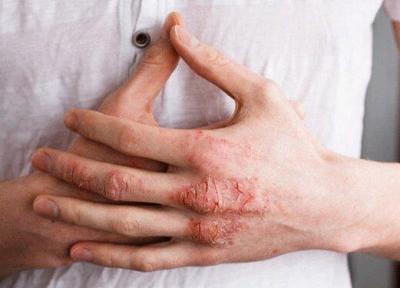 تقویت سیستم ایمنی به درمان بیماری اگزما کمک می کند