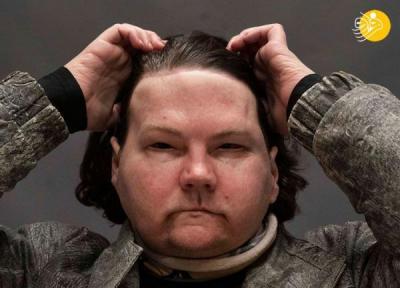 (تصاویر) زندگی دوباره مرد خوش شانس با چهره و دست های جدید!